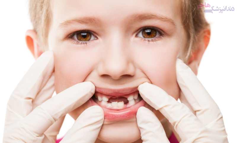 از دست دادن دندان زودهنگام دندان شیری